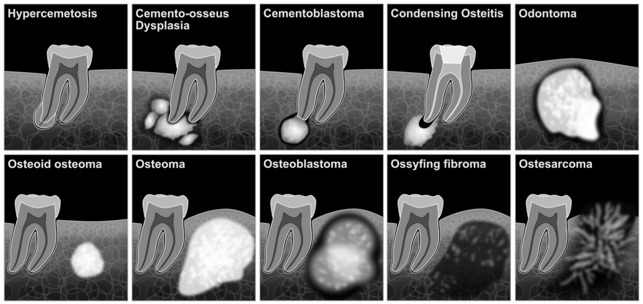 Radiopaque lesion pathology radiograph mandible inferior roots prior dentistryiq apical